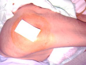 LESION (40)  IMAGENES FOTOS